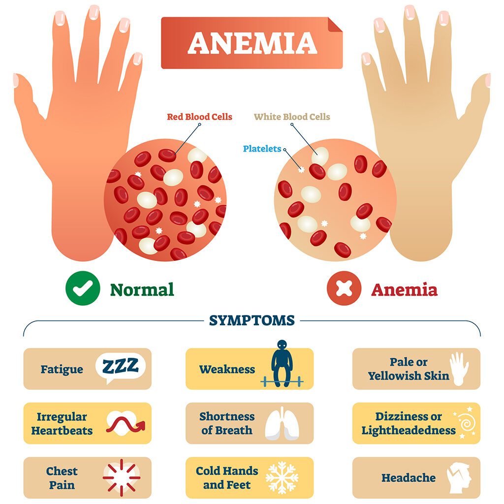 iron-deficiency-anemia-diet-restrictions